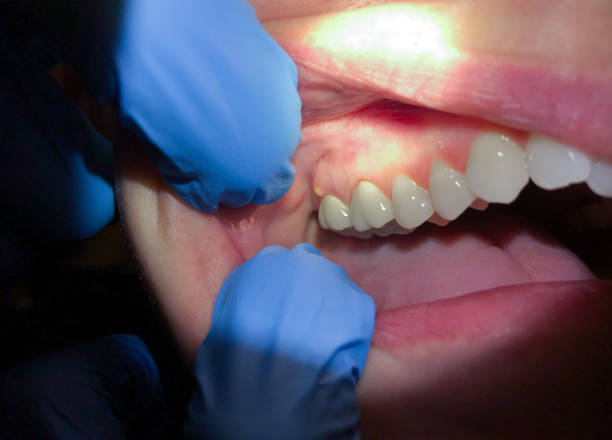 Best Emergency Treatment for Dental Infections or Abscesses in Thomasboro, IL